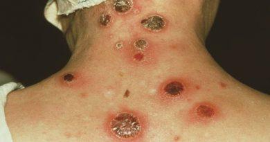 sickness disease ailment virus