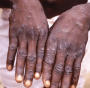 Monkeypox concern heightened after disease reached Europe and the Americas, says WHO