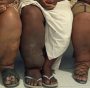 Elephantiasis sufferers in Nigeria are stigmatized