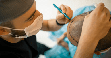 Hair Transplant in Nigeria