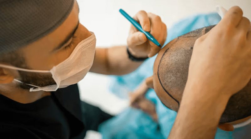 Hair Transplant in Nigeria